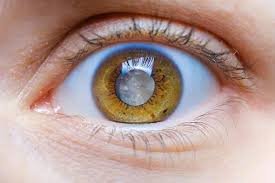 Cataracts Affect Vision